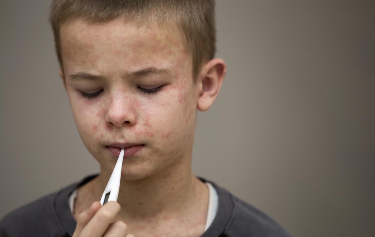 Ošpice | Ošpice niso neškodljiva otroška bolezen in se jih ne sme jemati zlahka, je opozoril avstrijski minister za zdravje Johannes Rauch.  | Foto Getty Images