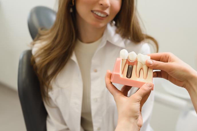 implatant, zobni vsadek, zobje, zobozdravnik | Foto Shutterstock