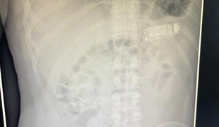 Kirurg moškemu iz želodca odstranil Nokio 3310 #foto