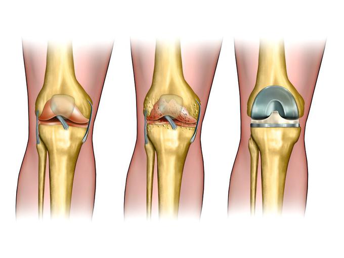 artroza-kolena-operacija | Foto: Medicofit