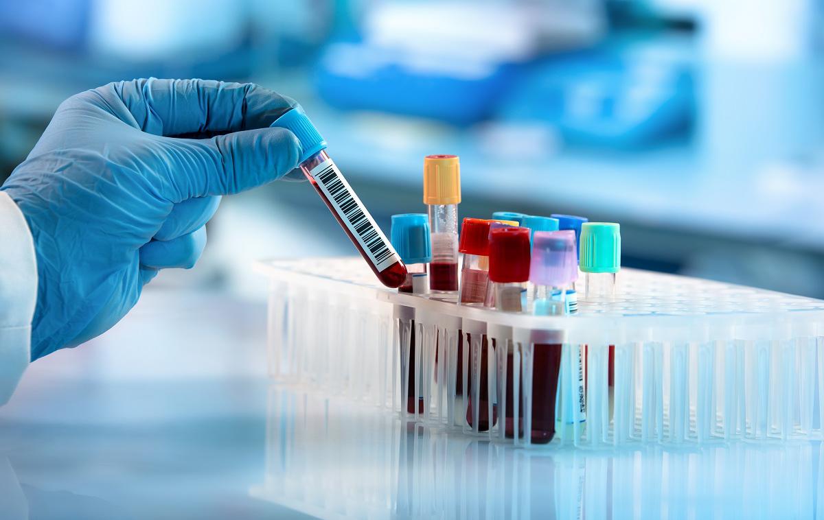 izvid krvi krvni test kri | Foto Shutterstock