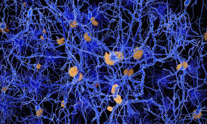 Amiloidne obloge (rjavo) na nevronih nakazujejo nastanek Alzheimerjeve bolezni. | Foto: RMIT