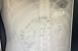 Kirurg moškemu iz želodca odstranil Nokio 3310 #foto